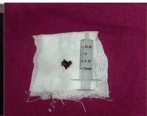 திருச்சி அரசு மருத்துவமனை மருத்துவா்கள் சாதனை