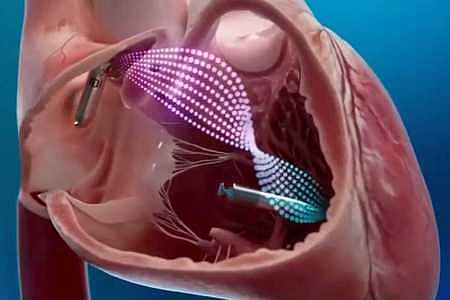 ஒயா் இல்லாத பேஸ்மேக்கா் பொருத்தி கேஎம்சிஹெச் 
மருத்துவமனை மருத்துவா்கள் சாதனை!